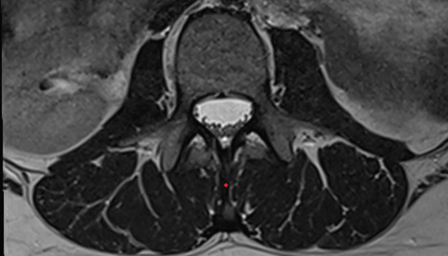 Interspinous ligament  mri sag image -img-00000-00000