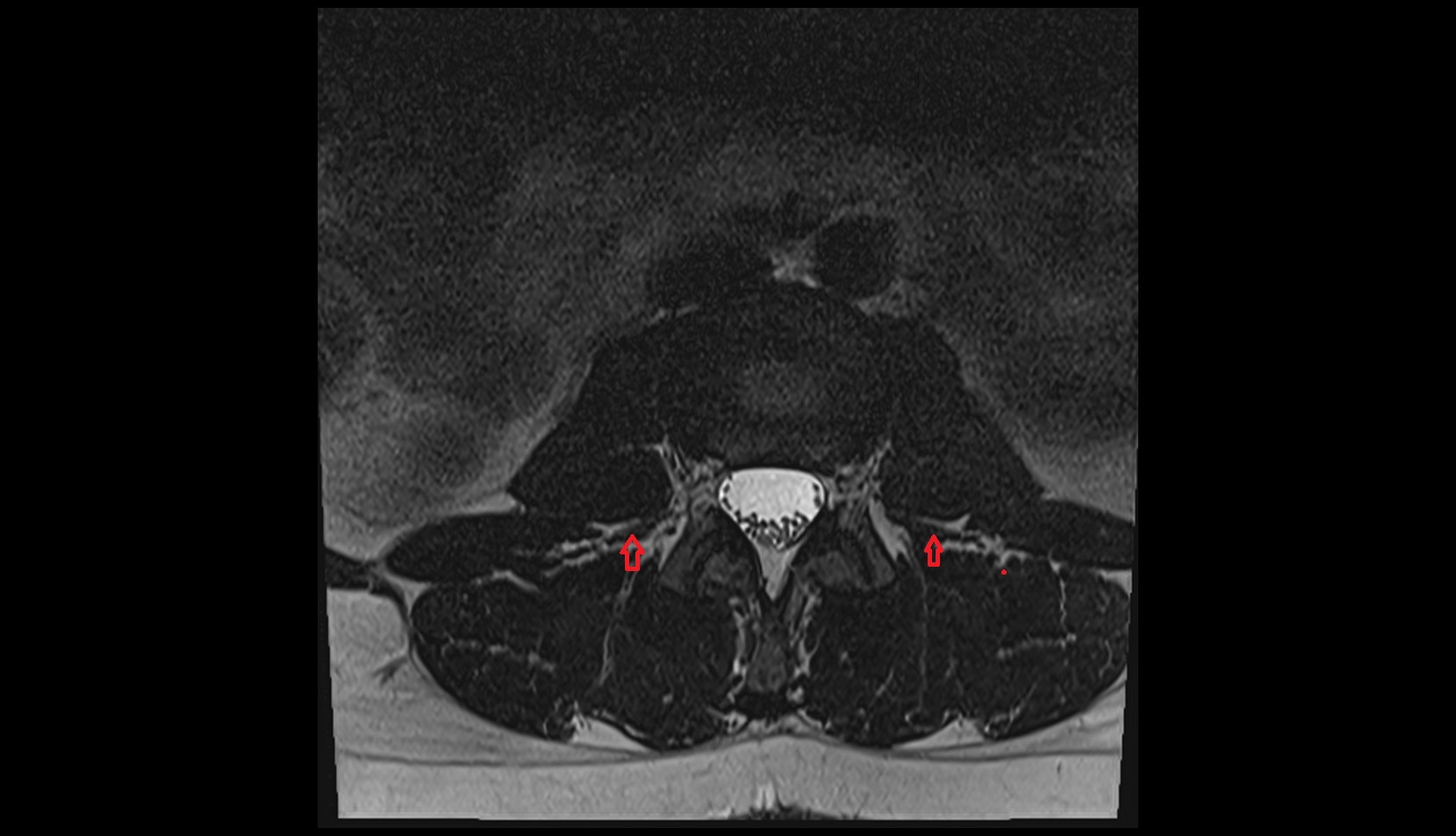 Intertransversarii muscle