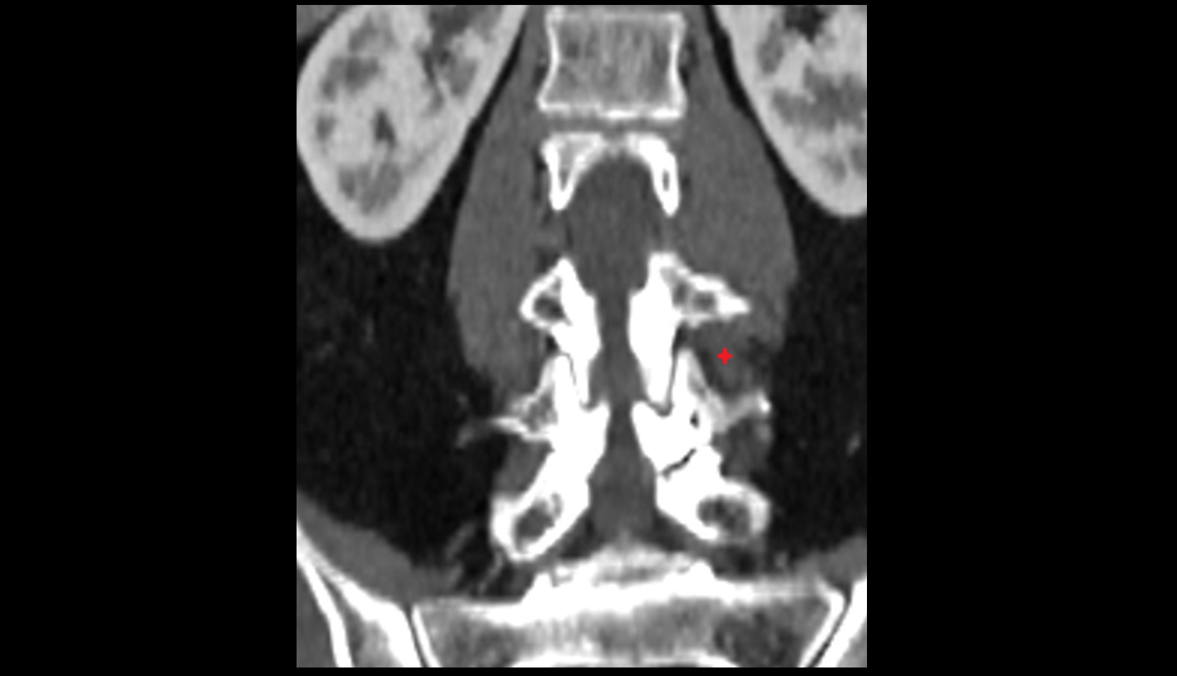Intertransversarii muscle CT image