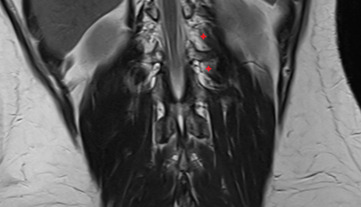 Intertransversarii muscle  MRI  coronal  image anatomy  image -img-00000-00000