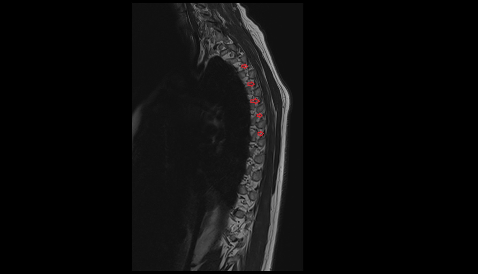 Intertransverse Ligament