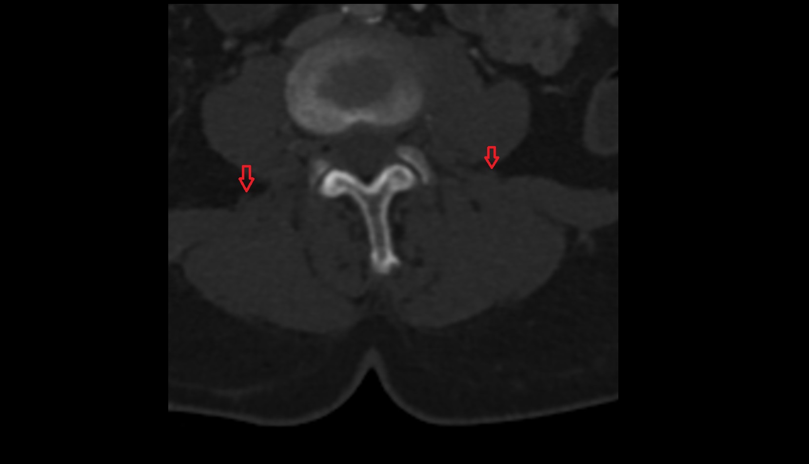 Intertransverse ligament ct axial image