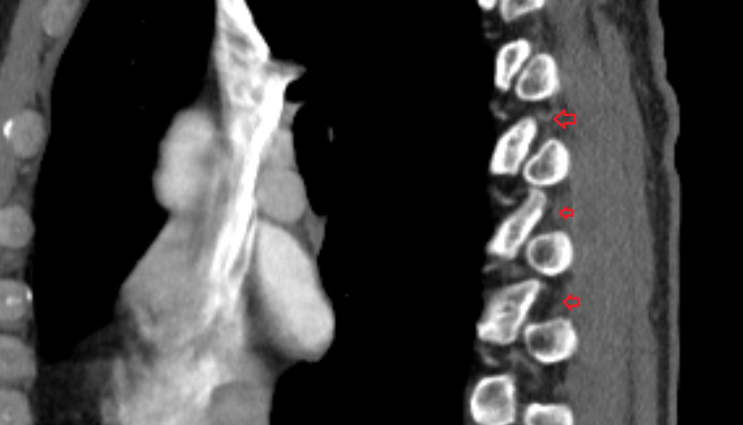 Intertransverse ligament ct  sagittal  image -img-00000-00000
