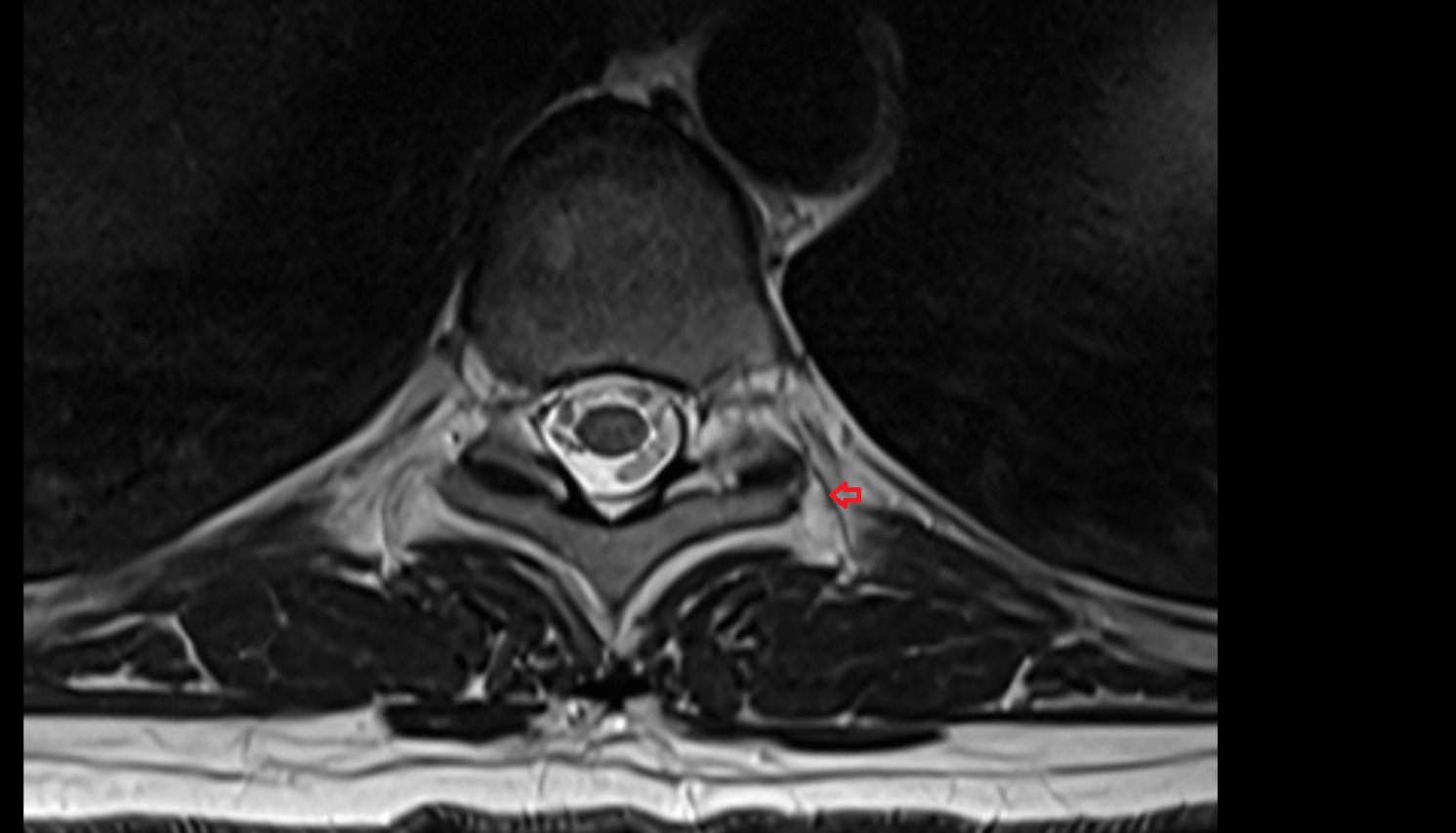 Intertransverse ligament mri axial  image -img-00000-00000