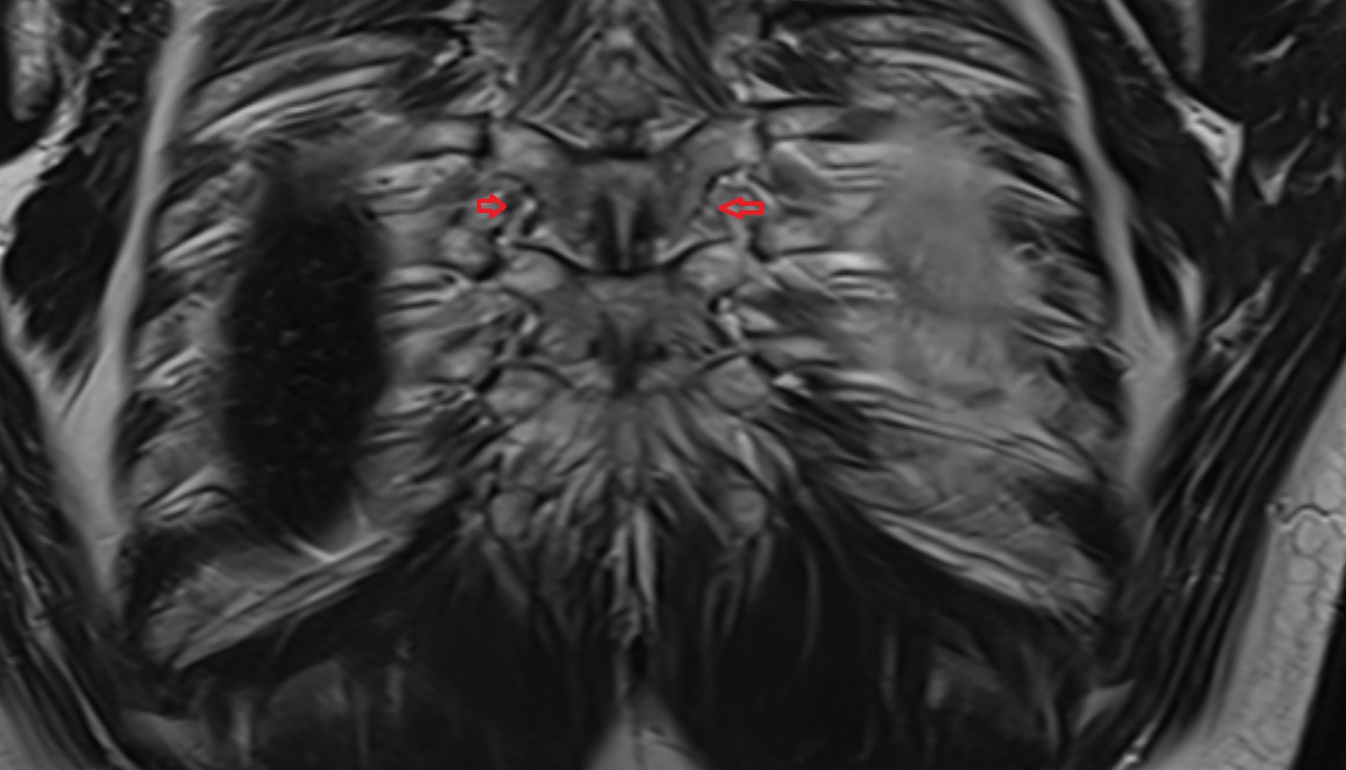 Intertransverse ligament mri  coronal  image -img-00000-00000