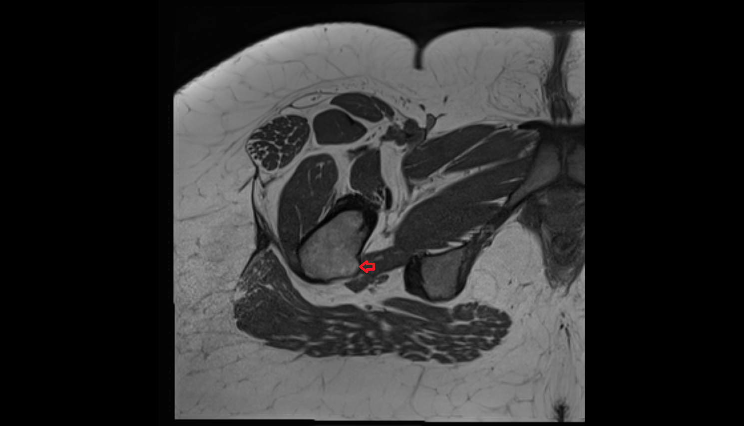 Intertrochanteric crest  MRI axial image-img-00000-00000