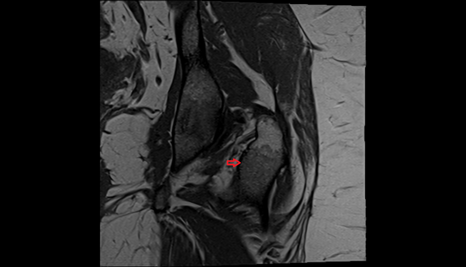 Intertrochanteric crest  MRI axial image-img-00000-00000_00001