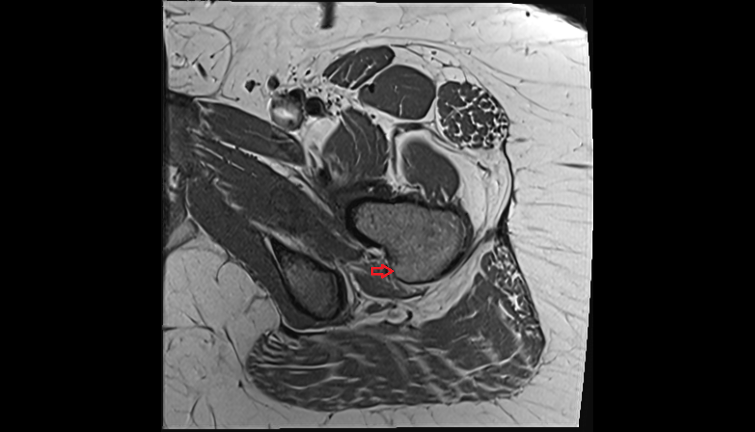 Intertrochanteric crest  MRI axial image-img-00000-00000_00002