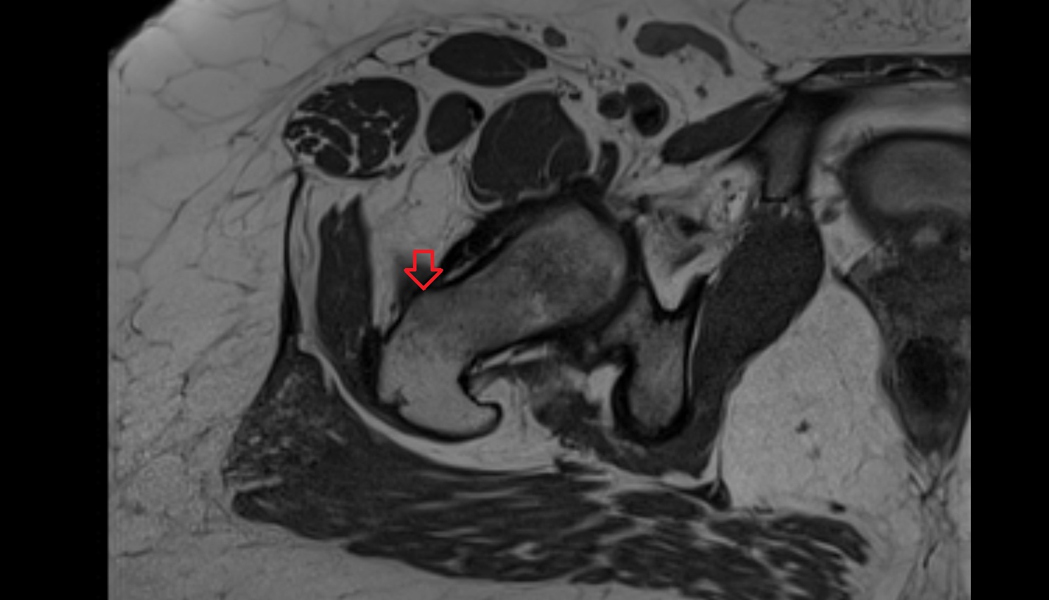 Intertrochanteric line  MRI  axial  anatomy  image-img-00000-00000