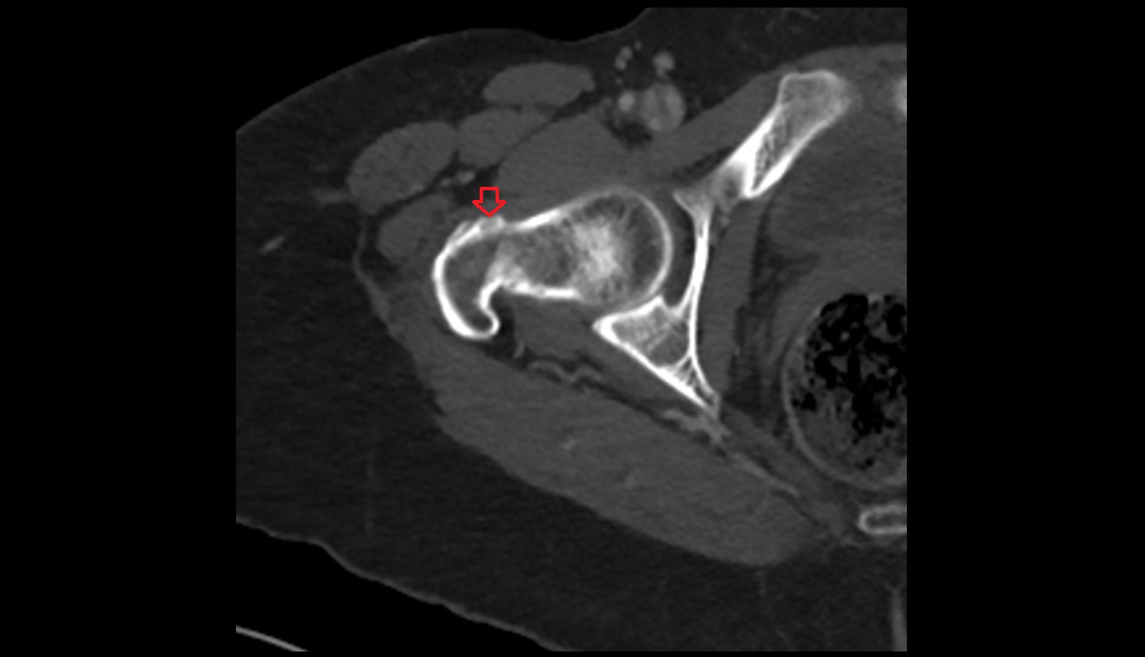 Intertrochanteric line ct axial image