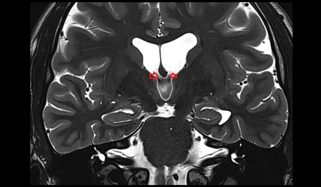Interventricular foramen (Monro) mri 3t coronal image