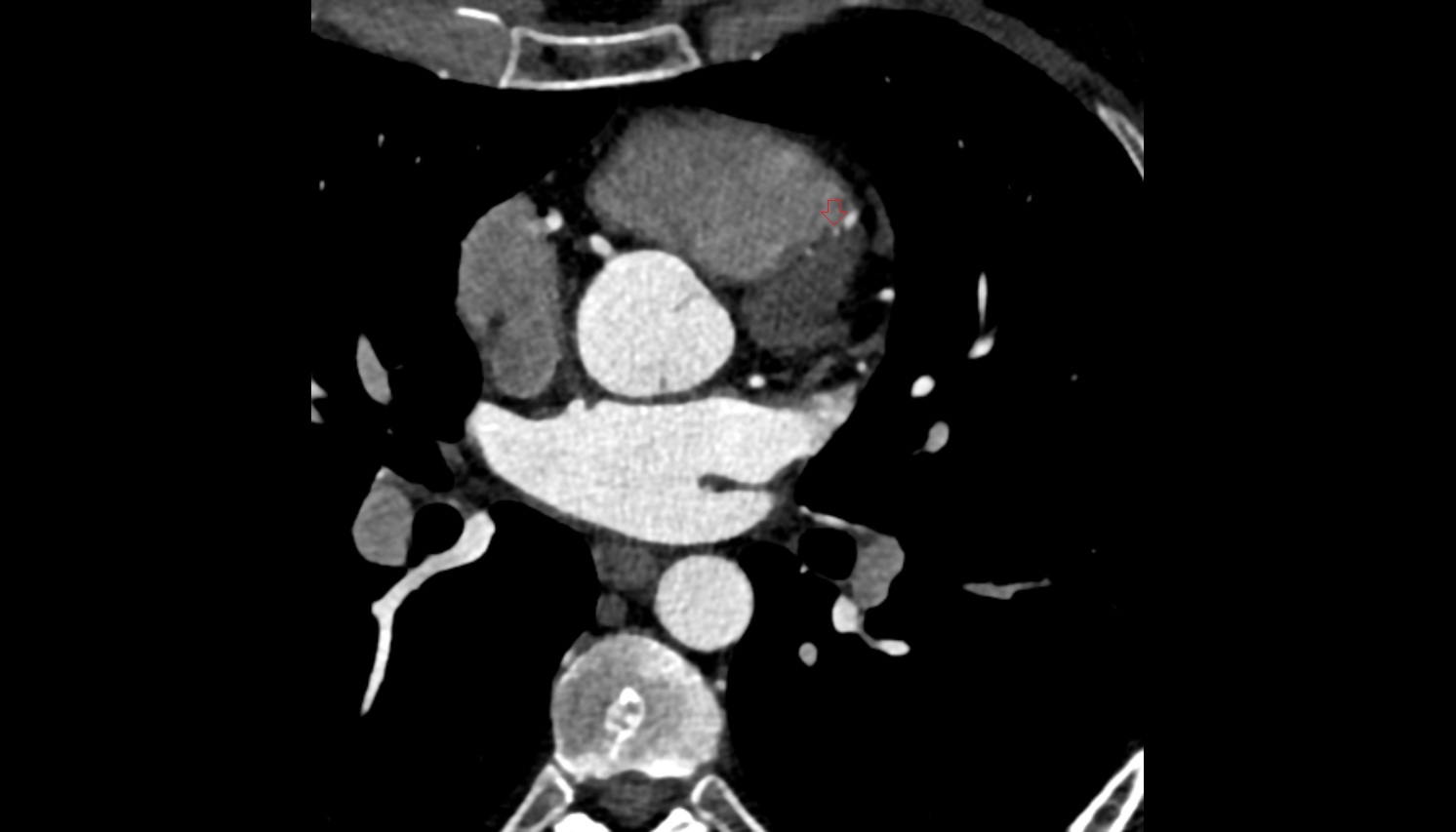 Interventricular septal branch S2  anantomy  CT  axial image -img-00000-00000