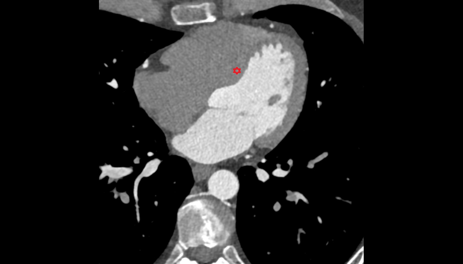 Interventricular septum  ct axial  image -img-00000-00000