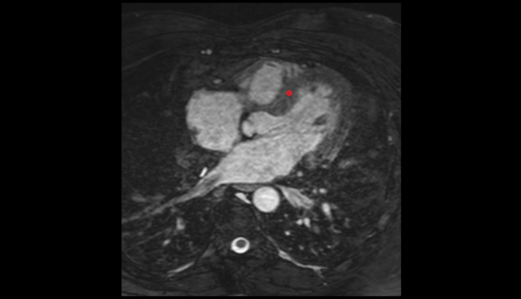 Interventricular septum mri image