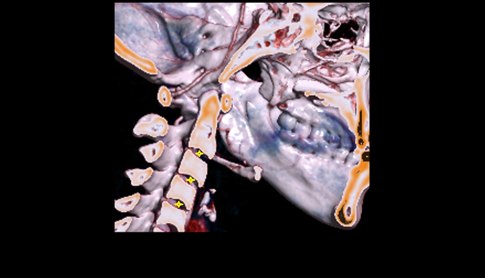 Intervertebral Disc Space