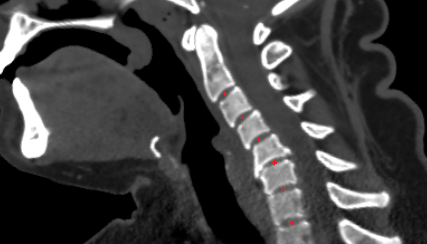 Intervertebral Disc Space of vertebra of  vertebra , Location and Imaging Appearance  -img-00000-00000