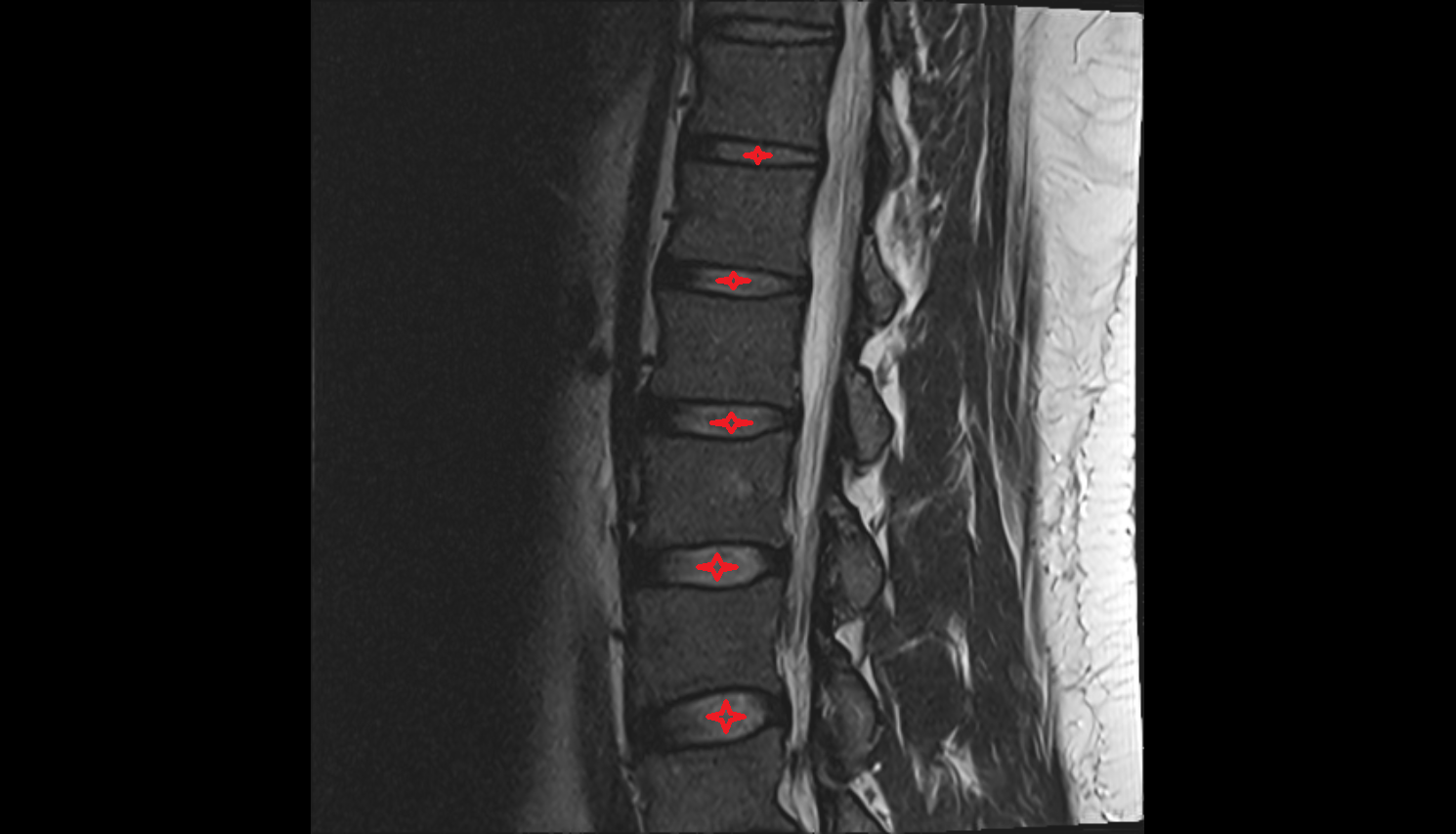 Intervertebral Disc Space of vertebra of  vertebra , Location and Imaging Appearance  -img-00000-00000_00001