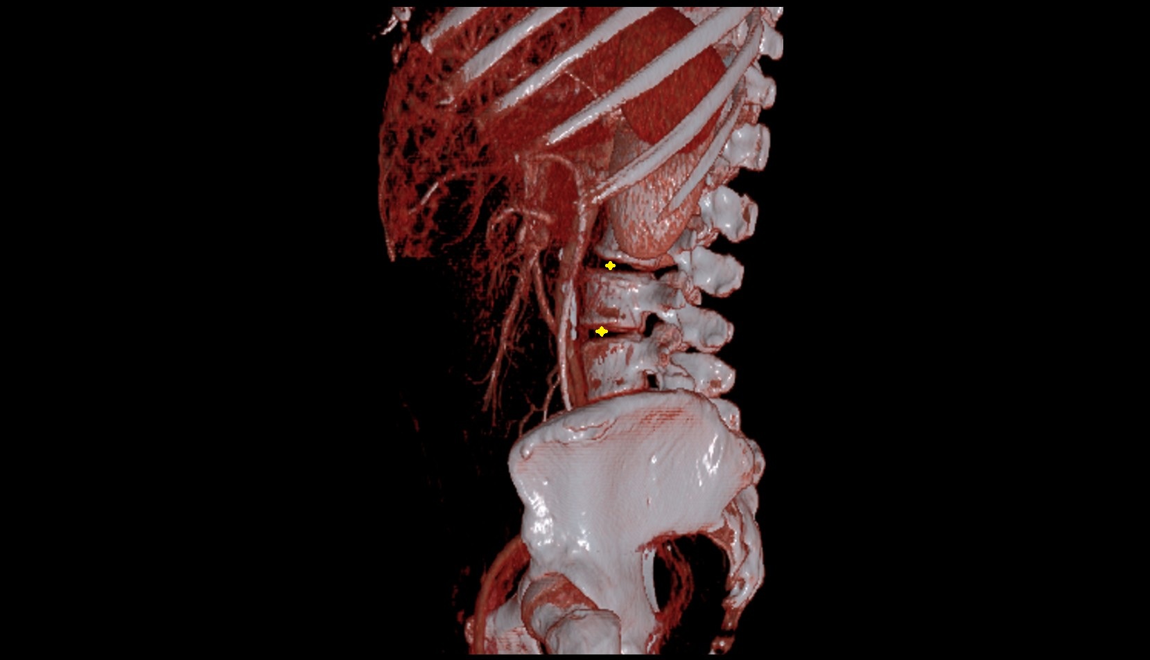 Intervertebral disc ct 3 image