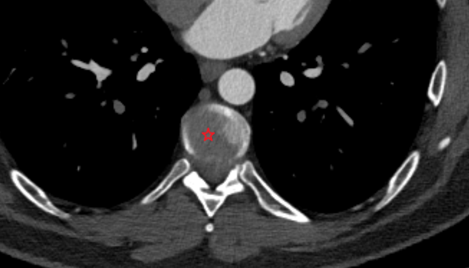 Intervertebral disc ct axial  image -img-00000-00000