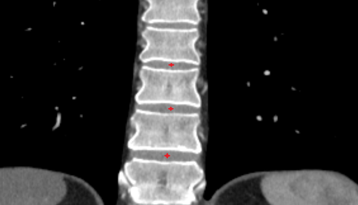 Intervertebral disc ct coronal  image -img-00000-00000
