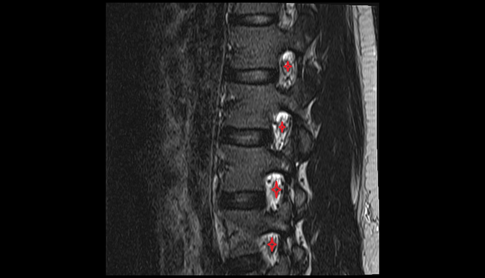 Intervertebral foramen MRI sagittal image