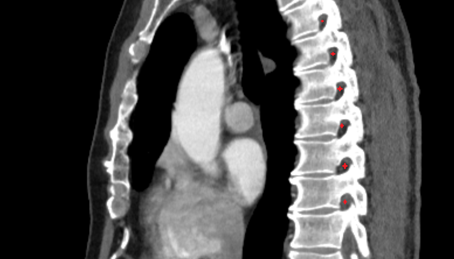 Intervertebral foramen  ct sag  image-img-00000-00000