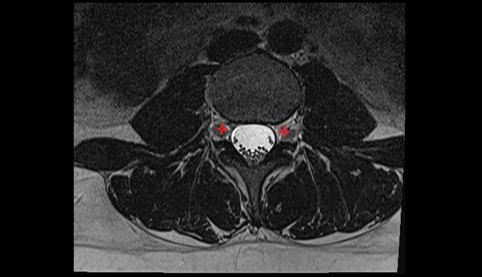 Intervertebral foramen mri axial image