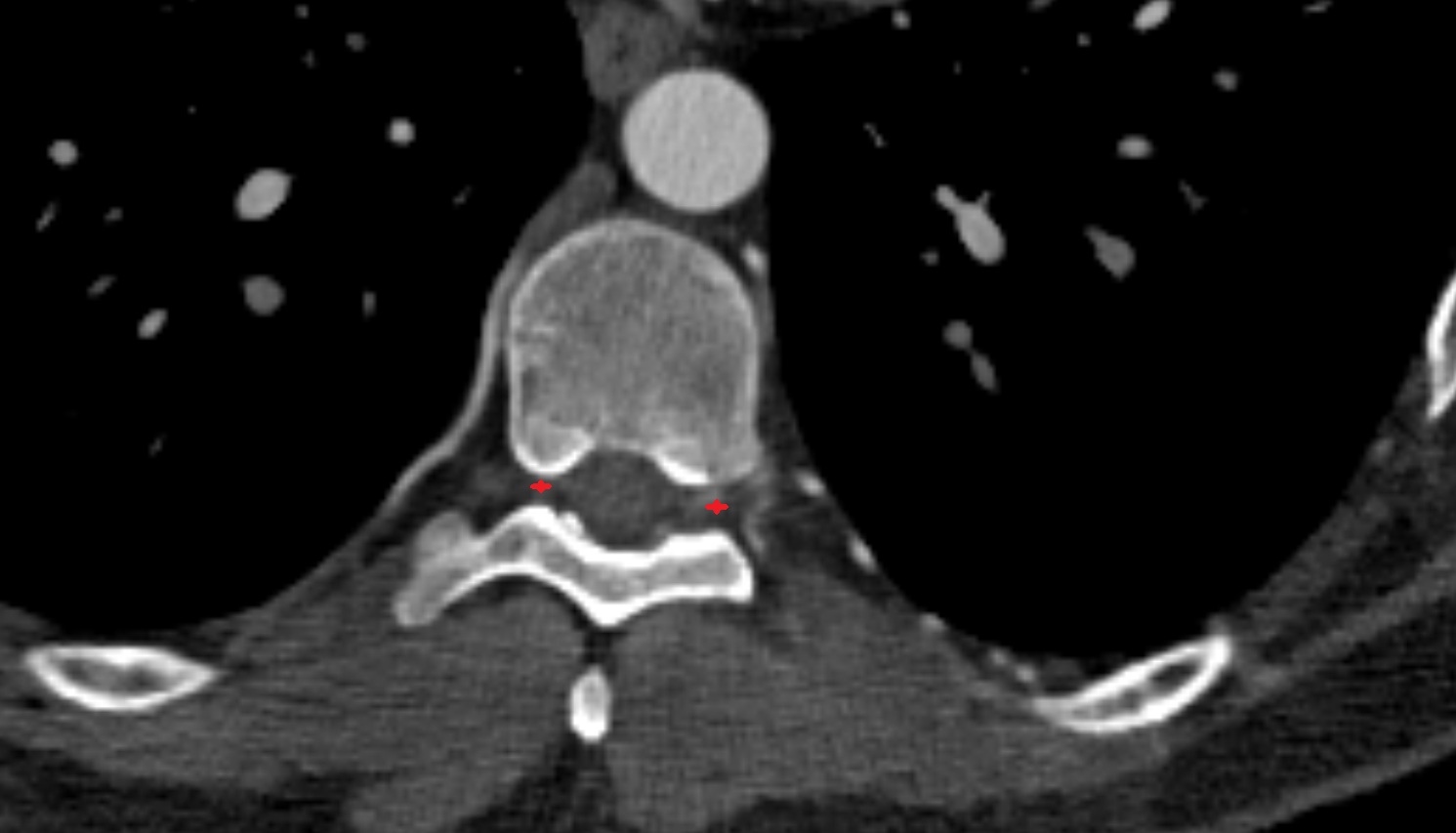 Intervertebral foramina ct axial  image -img-00000-00000