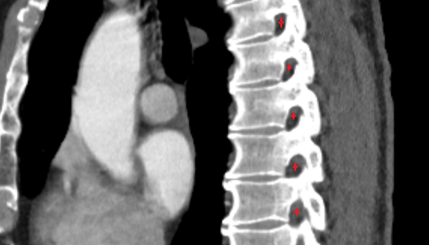 Intervertebral foramina ct  sagittal  image -img-00000-00000