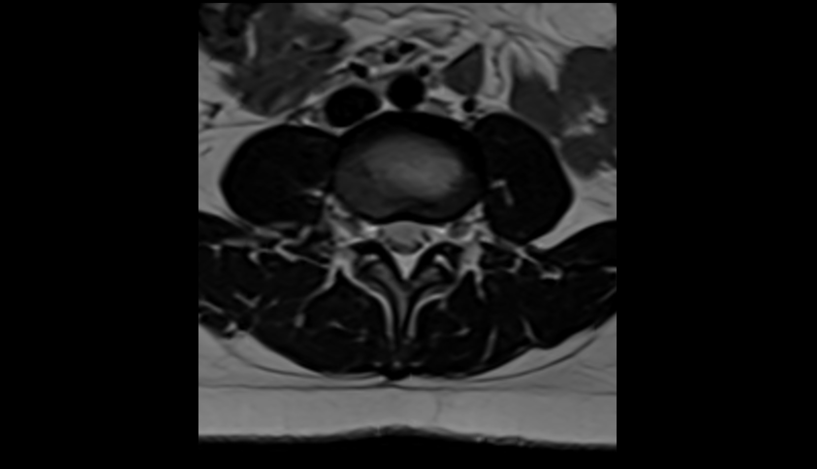 Intervertebral foramina mri axial