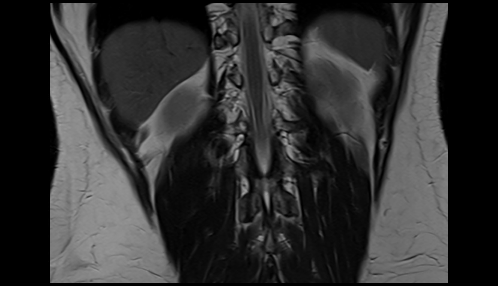 Intervertebral foraminamri coronal