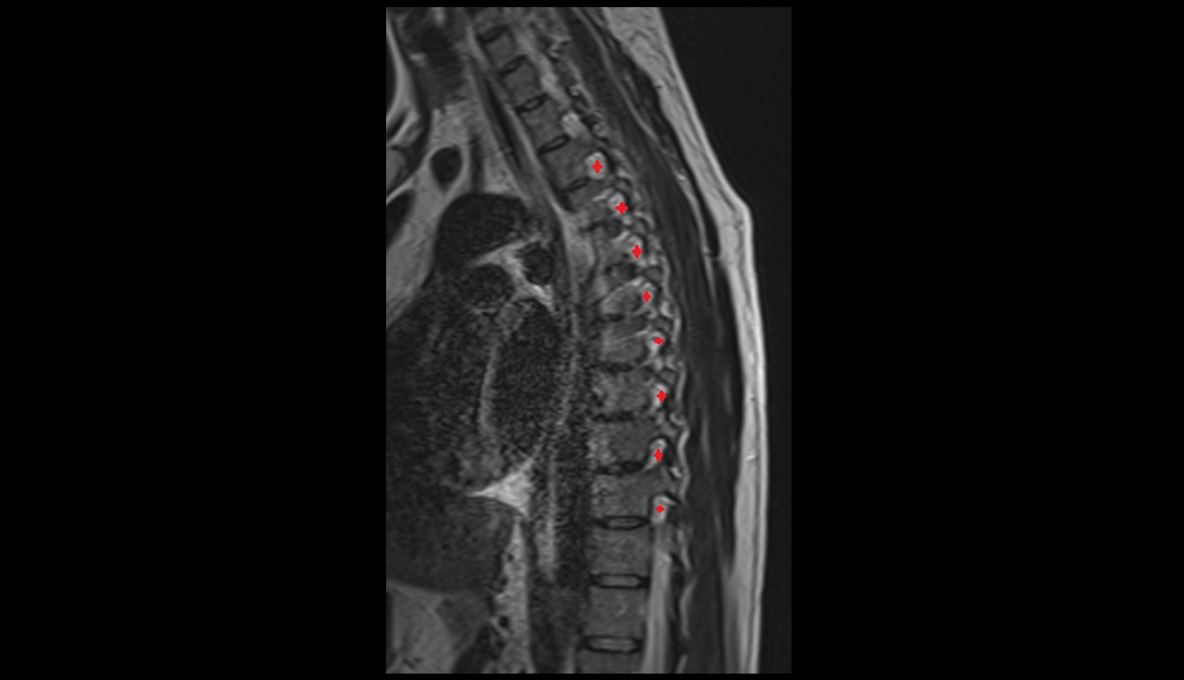 Intervertebral foramina mri  sagittal