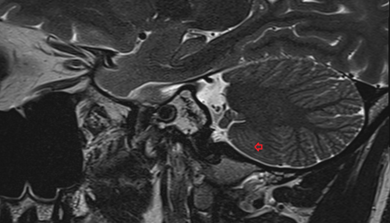 Intrabiventral fissure of Cerebellum  mri sag  image -img-00000-00000