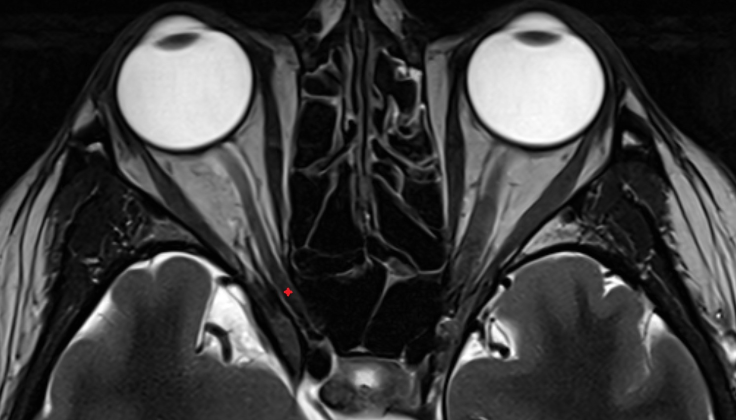 Intracanalicular part of optic nerve-img-00000-00000