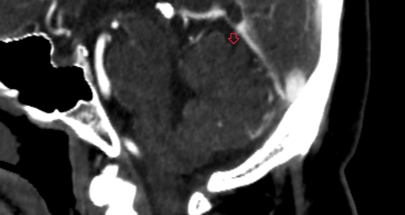 Intraculminate fissure  CT sag  anatomy image -img-00001-00001