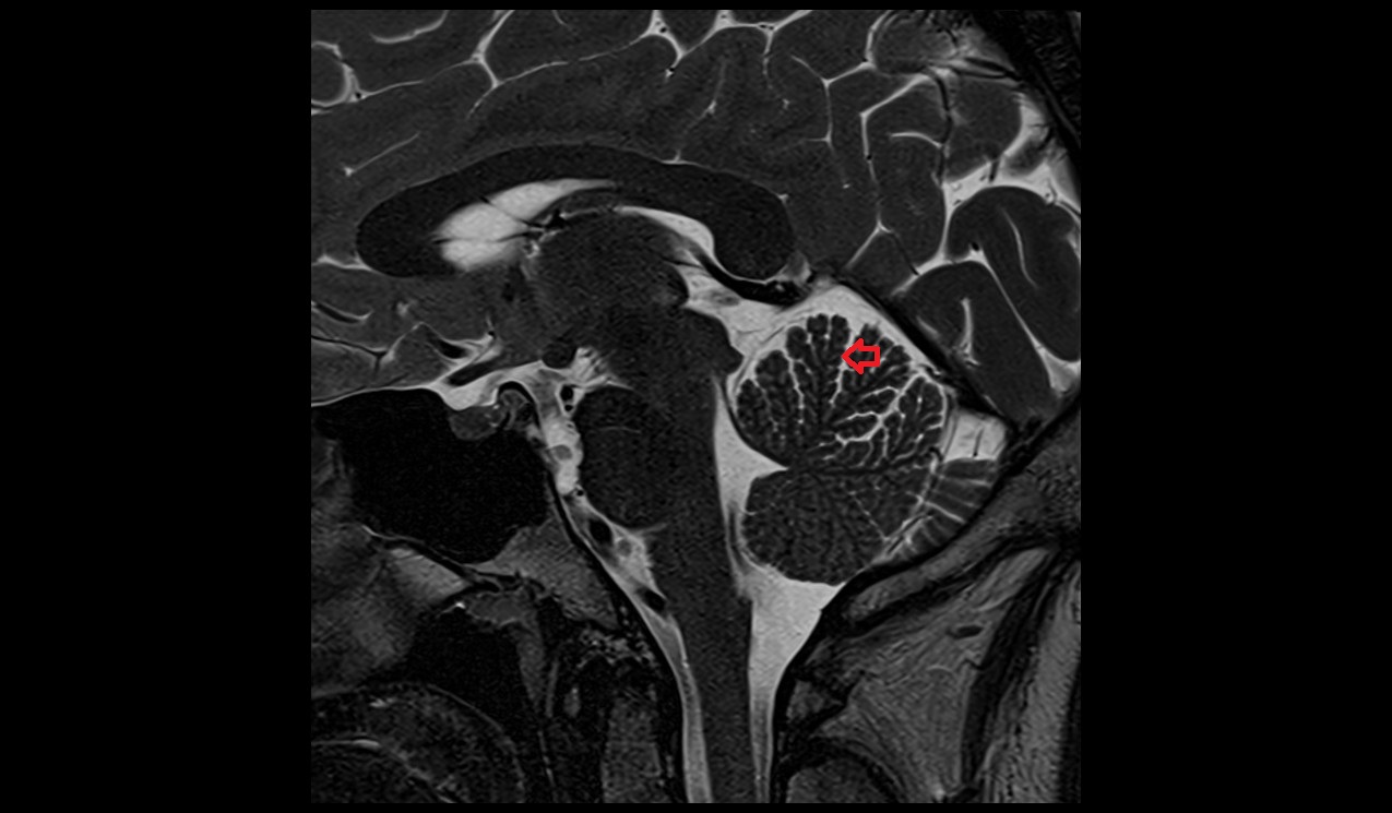 Intraculminate fissure MRI 3T sagittal image