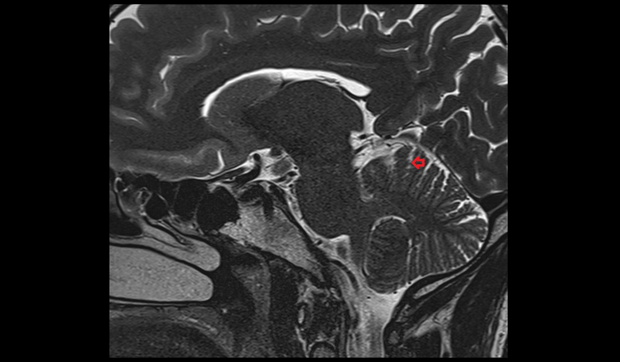 Intraculminate fissure MRI 3T sagittall image