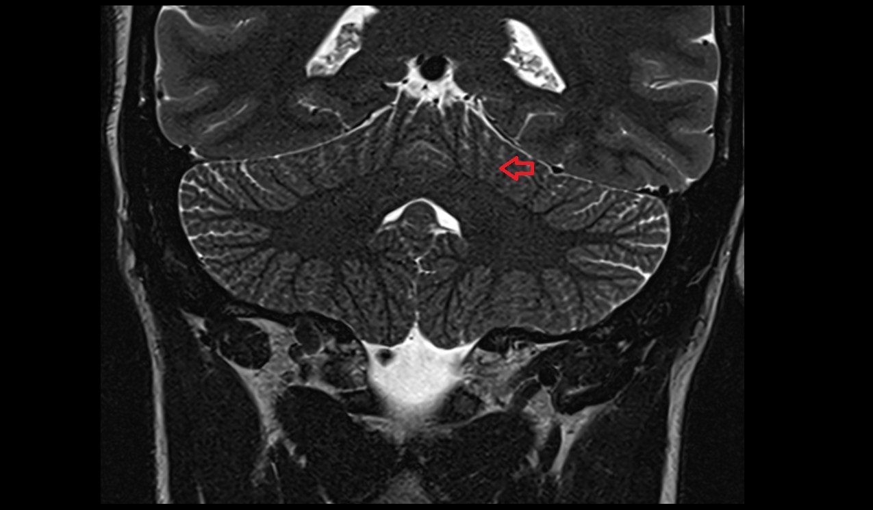 Intraculminate fissure mri coronal 3t image