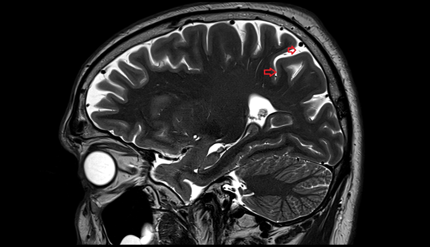 Intraparietal sulcus MRI 3Tsagittal image