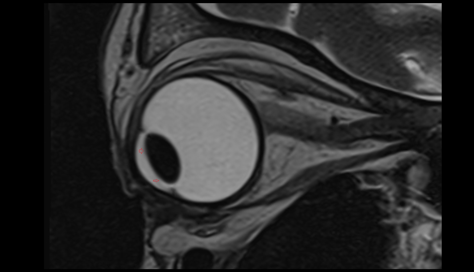 Iris mri sagittal image