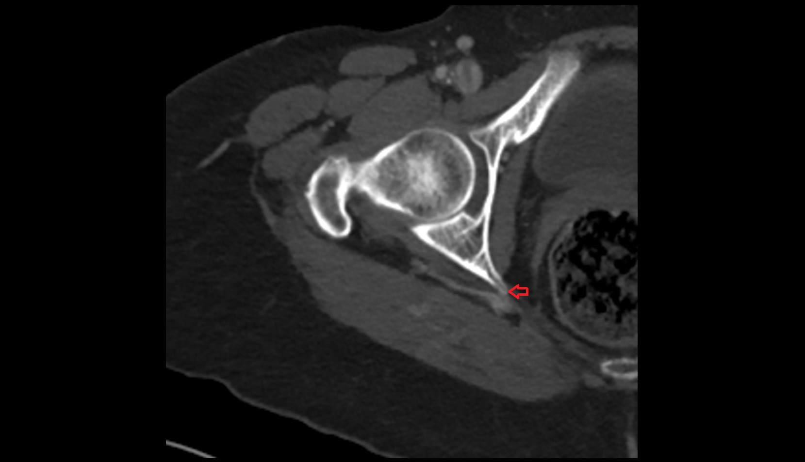 Ischial spine CT axial image