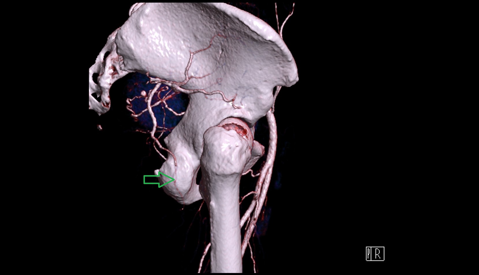 Ischial tuberosity 3D CT VRT anatomy  image