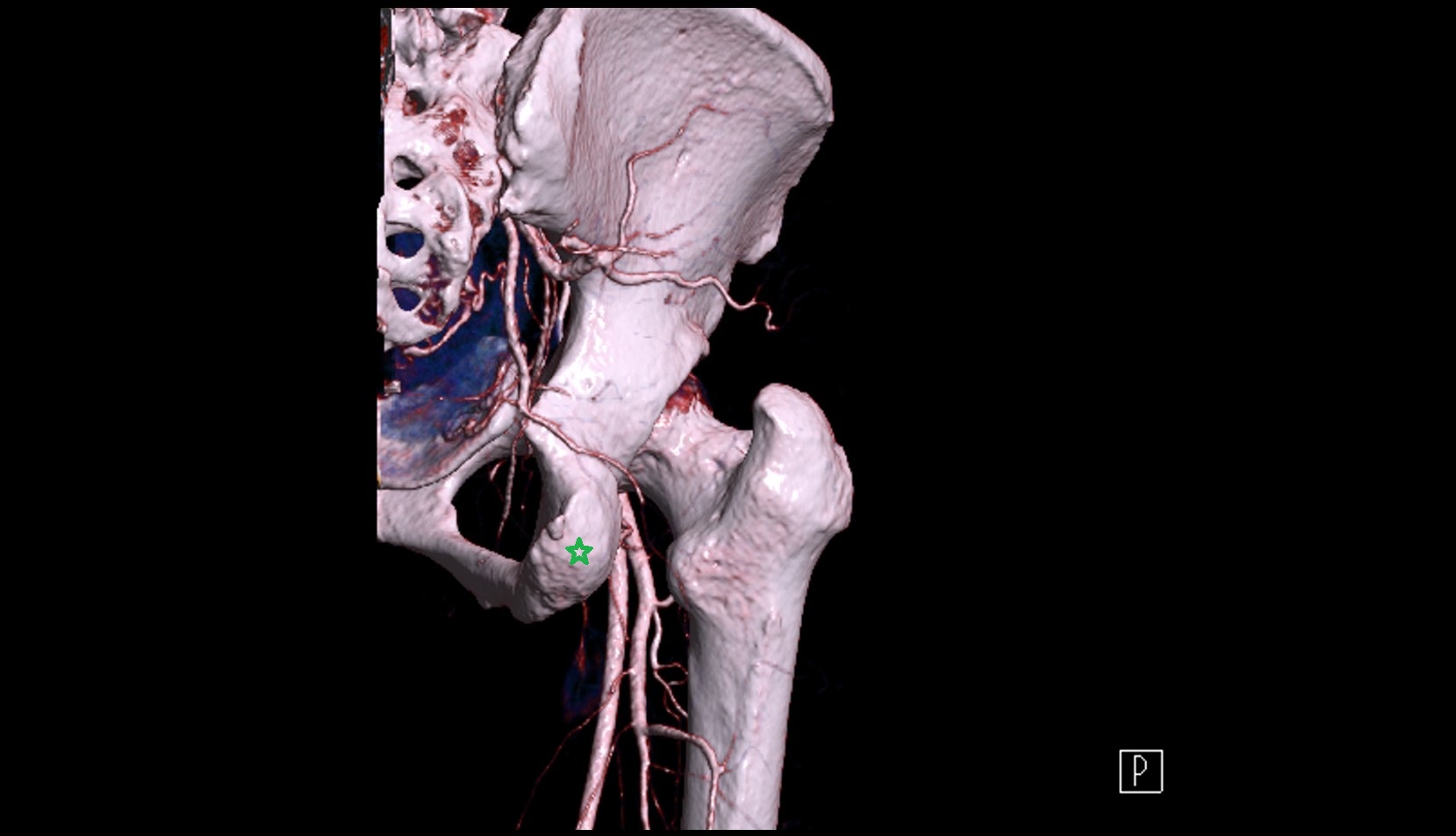 Ischial tuberosity 3D CT VRT anatomy  image 1