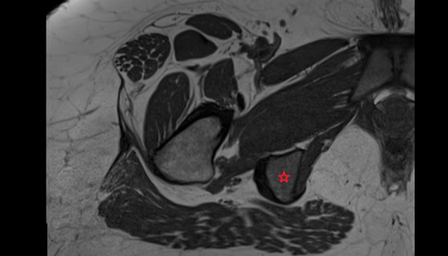 Ischial tuberosity MRI  axial  anatomy  image-img-00000-00000