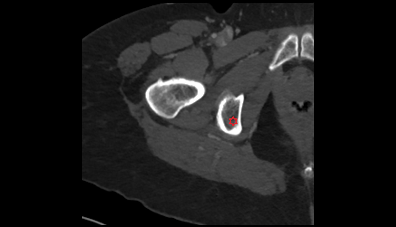 Ischial tuberosity ct axial image