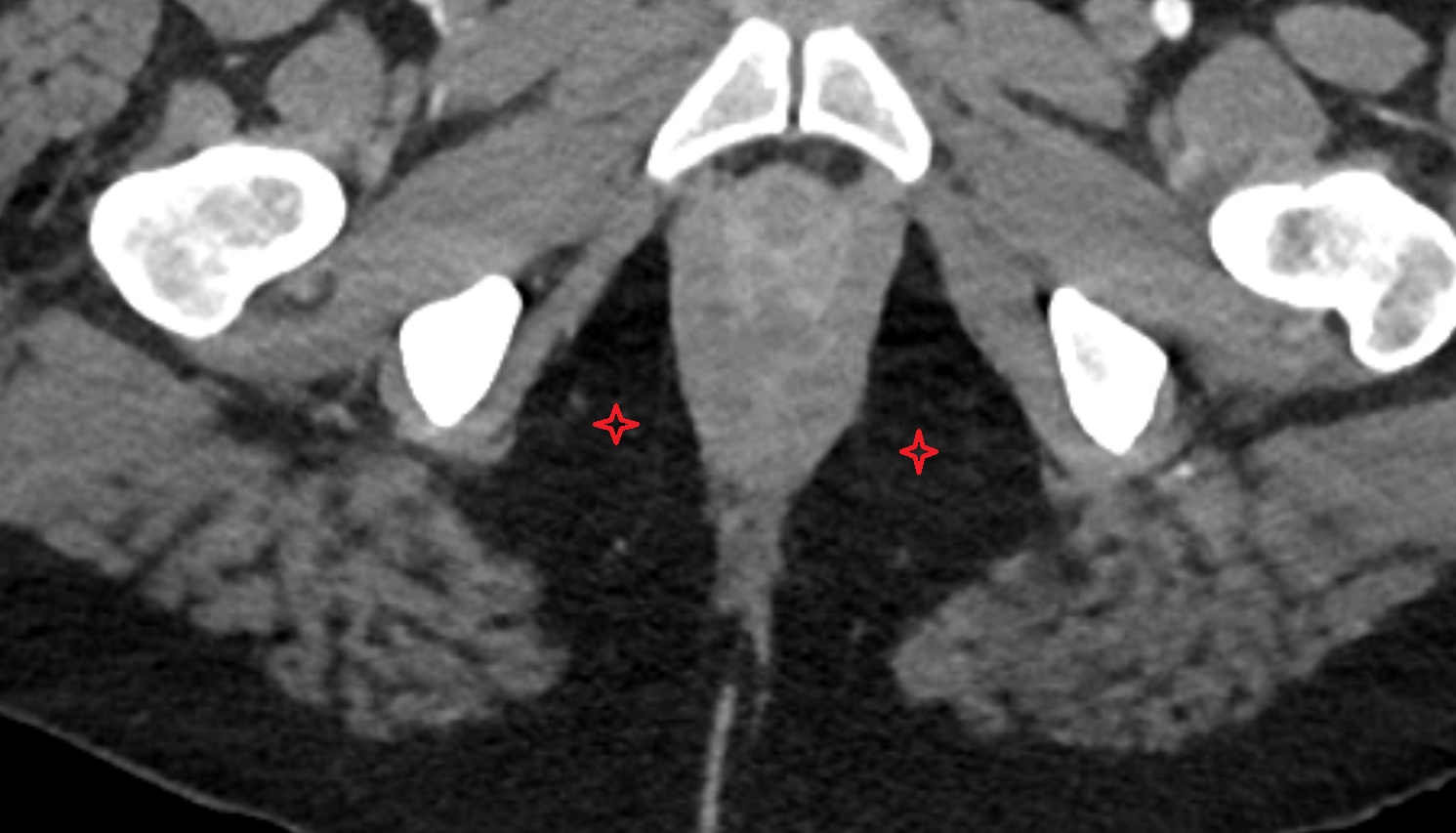 Ischioanal fossa  CT  axial  anatomy  image-img-00000-00000