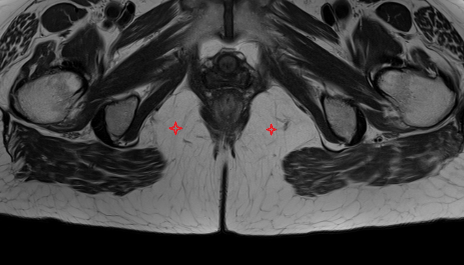 Ischioanal fossa  MRI axial  anatomy  image-img-00000-00000