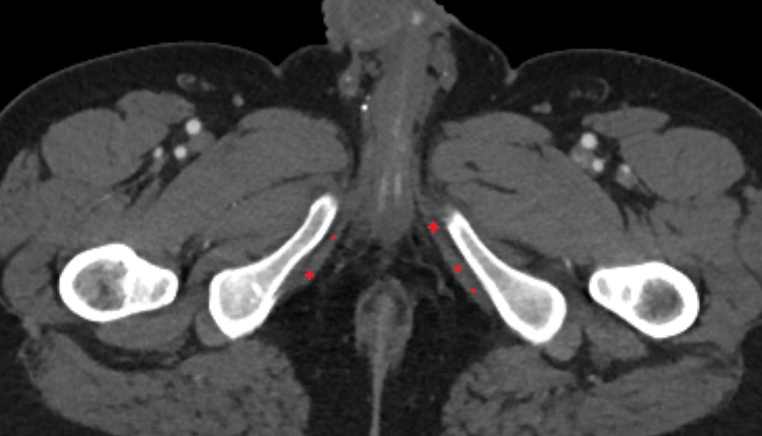 Ischiocavernosus (Male)  CT axial anatomy  image-img-00000-00000