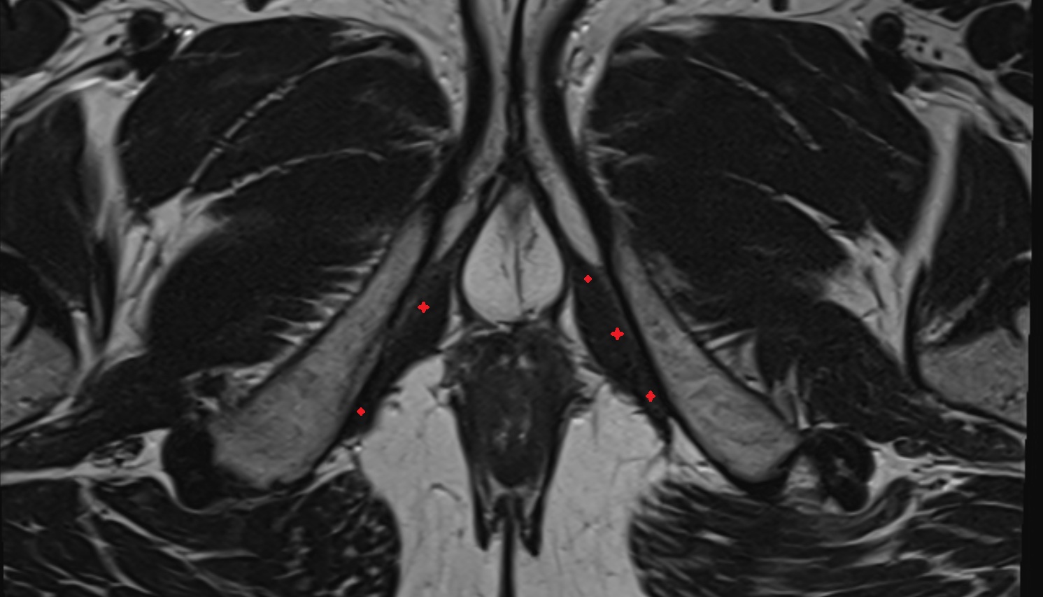 Ischiocavernosus (Male) MRI axial anatomy  image-img-00000-00000