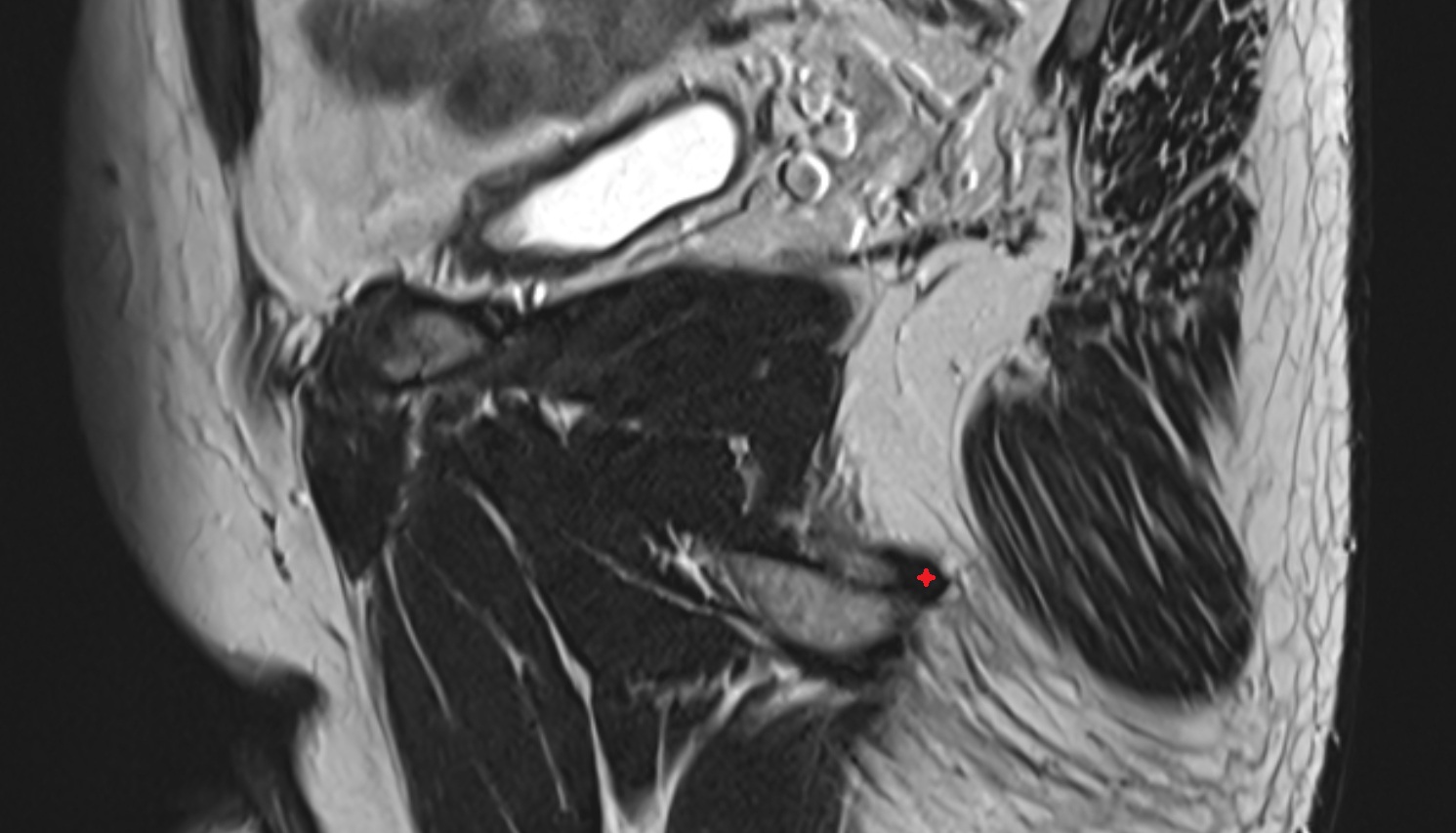 Ischiocavernosus (Male) MRI sagittal anatomy  image-img-00000-00000